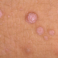 Warts